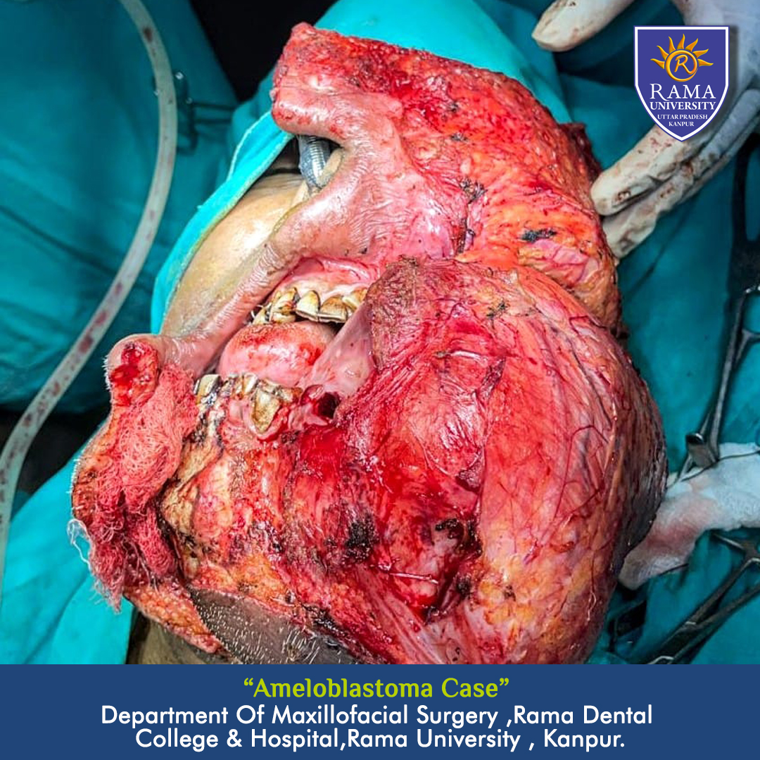 6_hour_surgery_for_large_ameloblastoma_2024